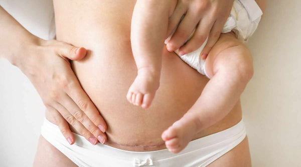 Hoe kan ik succesvol borstvoeding geven na een keizersnede?